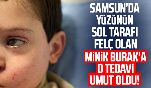 Samsun'da yüzünün sol tarafı felç olan minik Burak Akyasan'a o tedavi umut oldu!